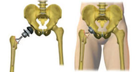 Minimally Invasive Hip Replacement