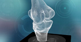 Conformis Knee Replacement